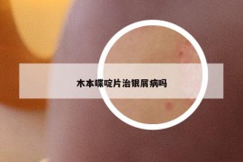 木本喋啶片治銀屑病嗎