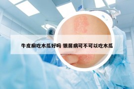 牛皮癬吃木瓜好嗎 銀屑病可不可以吃木瓜