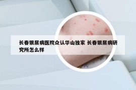 長春銀屑病醫(yī)院眾認華山獨家 長春銀屑病研究所怎么樣