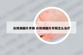 白斑病圖片早期 白斑病圖片早期怎么治療