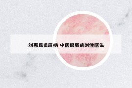 劉惠民銀屑病 中醫(yī)銀屑病劉佳醫(yī)生