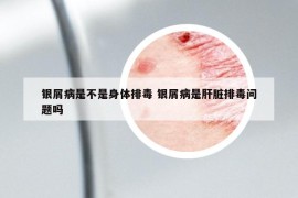 銀屑病是不是身體排毒 銀屑病是肝臟排毒問題嗎