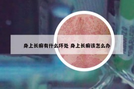 身上長(zhǎng)癬有什么壞處 身上長(zhǎng)癬該怎么辦