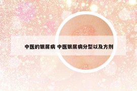 中醫(yī)的銀屑病 中醫(yī)銀屑病分型以及方劑