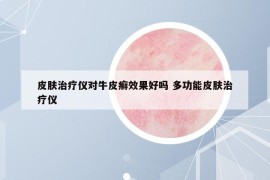 皮膚治療儀對牛皮癬效果好嗎 多功能皮膚治療儀