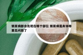 銀屑病都會(huì)出現(xiàn)在哪個(gè)部位 銀屑病是身體哪里出問(wèn)題了