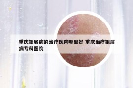 重慶銀屑病的治療醫(yī)院哪里好 重慶治療銀屑病?？漆t(yī)院
