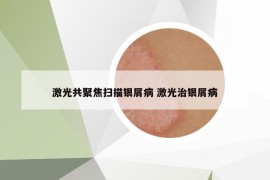 激光共聚焦掃描銀屑病 激光治銀屑病