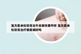 復(fù)方氟米松軟膏治牛皮癬效果咋樣 復(fù)方氟米松軟膏治療銀屑病好嗎