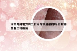 河南開封地方有三針治療銀屑病的嗎 開封哪里有三針疫苗