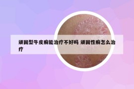 頑固型牛皮癬能治療不好嗎 頑固性癬怎么治療