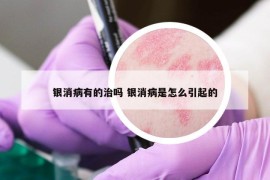 銀消病有的治嗎 銀消病是怎么引起的