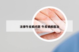 法律牛皮癬問題 牛皮病癬醫(yī)治