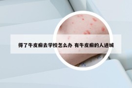 得了牛皮癬去學(xué)校怎么辦 有牛皮癬的人進(jìn)城