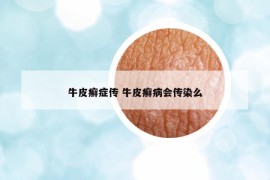 牛皮癬癥傳 牛皮癬病會(huì)傳染么