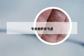 牛皮癬肝腎虧虛