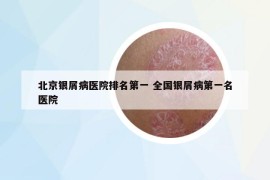 北京銀屑病醫(yī)院排名第一 全國銀屑病第一名醫(yī)院