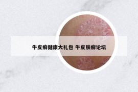 牛皮癬健康大禮包 牛皮膚癬論壇
