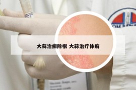 大蒜治癬除根 大蒜治療體癬