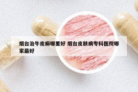 煙臺(tái)治牛皮癬哪里好 煙臺(tái)皮膚病專科醫(yī)院哪家最好