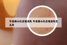 牛皮癬小紅點難消失 牛皮癬小紅點難消失怎么辦