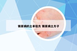 銀屑病的土單驗(yàn)方 銀屑病土方子