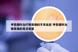 甲氨蝶呤治療銀屑病的不良反應(yīng) 甲氨蝶呤治銀屑病的用法用量