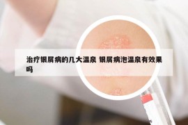 治療銀屑病的幾大溫泉 銀屑病泡溫泉有效果嗎