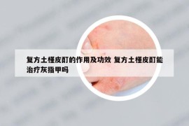 復(fù)方土槿皮酊的作用及功效 復(fù)方土槿皮酊能治療灰指甲嗎