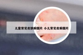 兒童常見皮膚癬圖片 小兒常見皮癬圖片