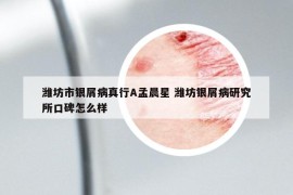濰坊市銀屑病真行A孟晨星 濰坊銀屑病研究所口碑怎么樣