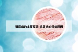 銀屑病的主要原因 銀屑病的得病原因