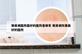 銀屑病醫(yī)院最好的醫(yī)院是哪家 銀屑病效果最好的醫(yī)院
