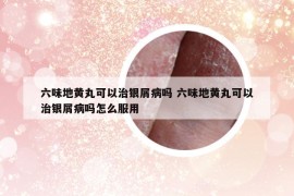 六味地黃丸可以治銀屑病嗎 六味地黃丸可以治銀屑病嗎怎么服用