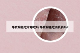 牛皮癬能吃苯那敏嗎 牛皮癬能吃消炎藥嗎?