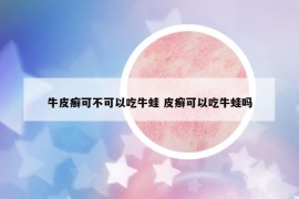 牛皮癬可不可以吃牛蛙 皮癬可以吃牛蛙嗎