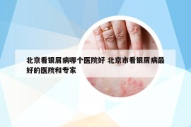 北京看銀屑病哪個醫(yī)院好 北京市看銀屑病最好的醫(yī)院和專家