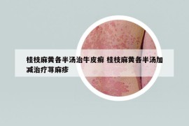 桂枝麻黃各半湯治牛皮癬 桂枝麻黃各半湯加減治療蕁麻疹