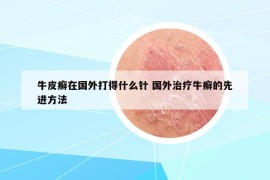 牛皮癬在國外打得什么針 國外治療牛癬的先進方法