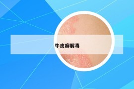 牛皮癬解毒