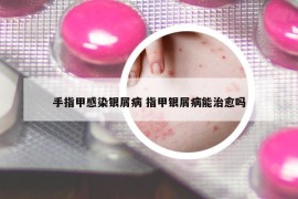 手指甲感染銀屑病 指甲銀屑病能治愈嗎