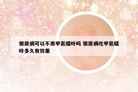 銀屑病可以不用甲氨蝶呤嗎 銀屑病吃甲氨蝶呤多久有效果