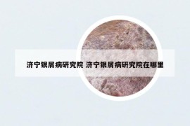 濟(jì)寧銀屑病研究院 濟(jì)寧銀屑病研究院在哪里