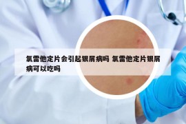 氯雷他定片會(huì)引起銀屑病嗎 氯雷他定片銀屑病可以吃嗎