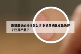 副銀屑病的痘痘怎么消 副銀屑病起皮是快好了還是嚴(yán)重了