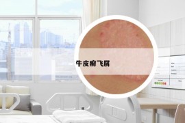 牛皮癬飛屑