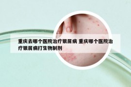 重慶去哪個(gè)醫(yī)院治療銀屑病 重慶哪個(gè)醫(yī)院治療銀屑病打生物制劑