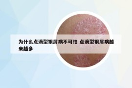 為什么點(diǎn)滴型銀屑病不可怕 點(diǎn)滴型銀屑病越來越多