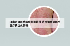 濟(jì)南市銀屑病醫(yī)院能報(bào)銷嗎 濟(jì)南銀屑病醫(yī)院醫(yī)療費(fèi)這么貴啊