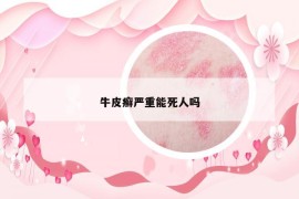 牛皮癬嚴(yán)重能死人嗎